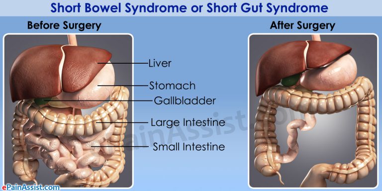 Short Bowel Syndrome or Short Gut Syndrome: Causes, Symptoms, Diagnosis, Treatment