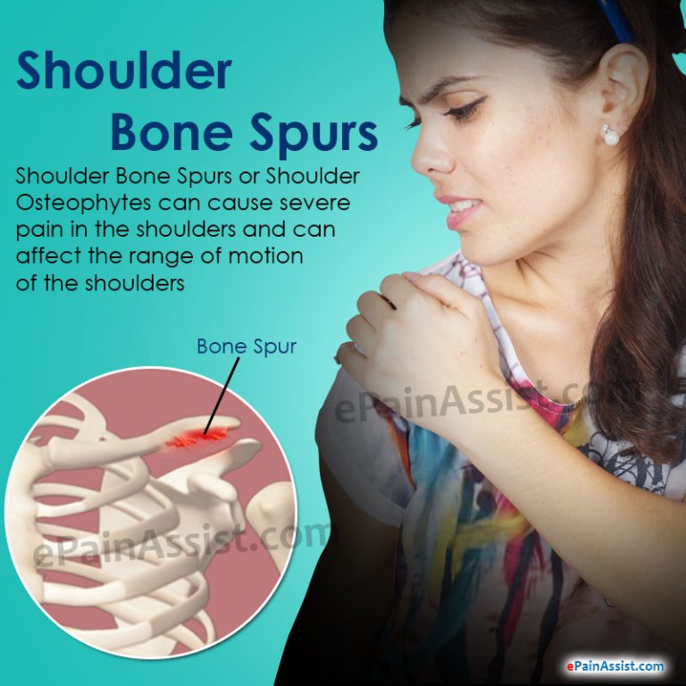 Shoulder Bone Spurs: Causes, Symptoms, Diagnosis, Treatment