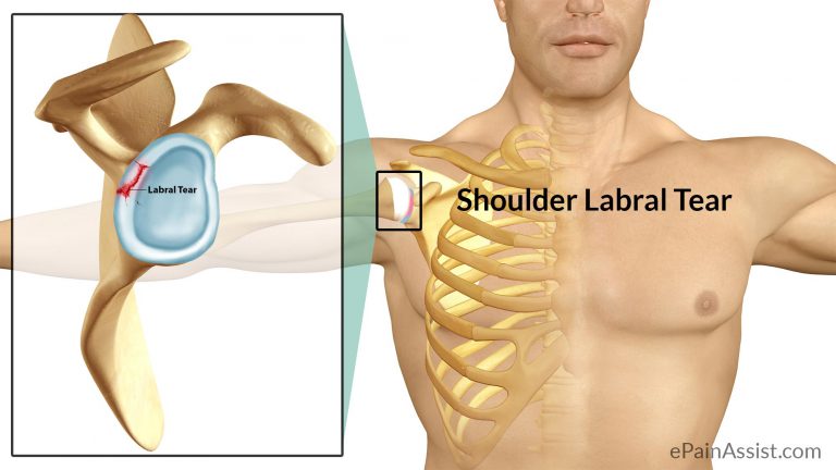 Shoulder Labral Tear Or Shoulder Joint Tear: Causes, Symptoms, Diagnosis, Treatment, Surgery, Rehab
