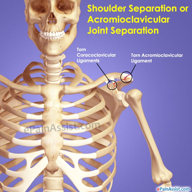 Shoulder Separation or Acromioclavicular Joint Separation: Causes, Symptoms, Diagnosis, Treatment, Exercise