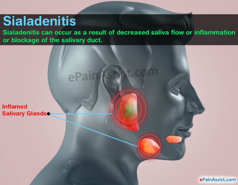 Sialadenitis: Causes, Signs, Symptoms, Treatment, Home Remedies, Prevention