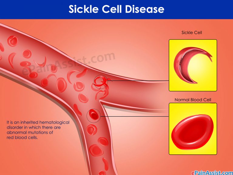 Does Sickle Cell Disease Qualify For Disability Benefits?