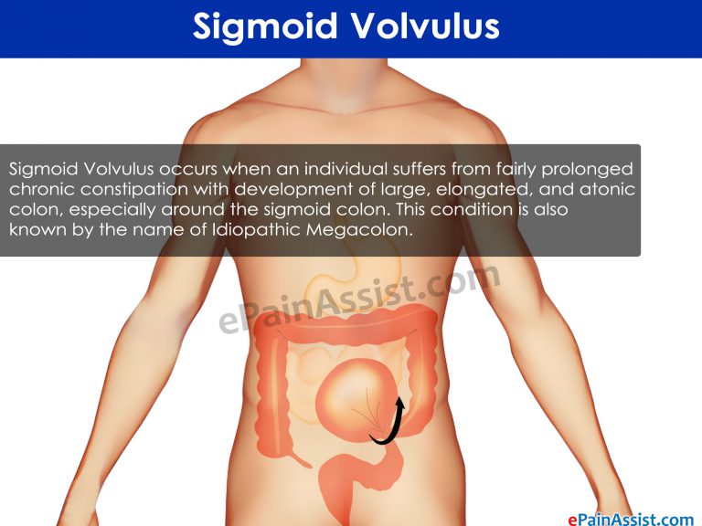 Sigmoid Volvulus