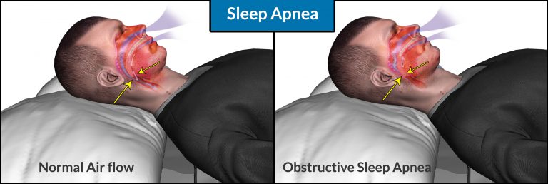 Sleep Apnea: Causes, Symptoms, Dangers, Self Treatment, CPAP Therapy Treatment, Tips
