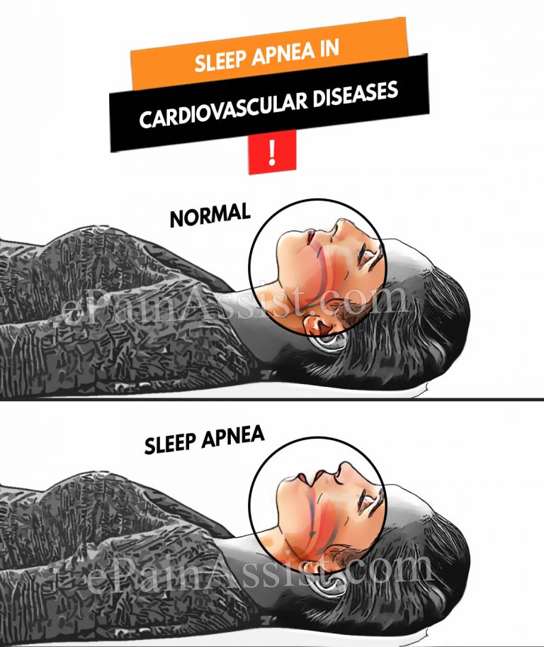 Sleep Apnea in Cardiovascular Diseases