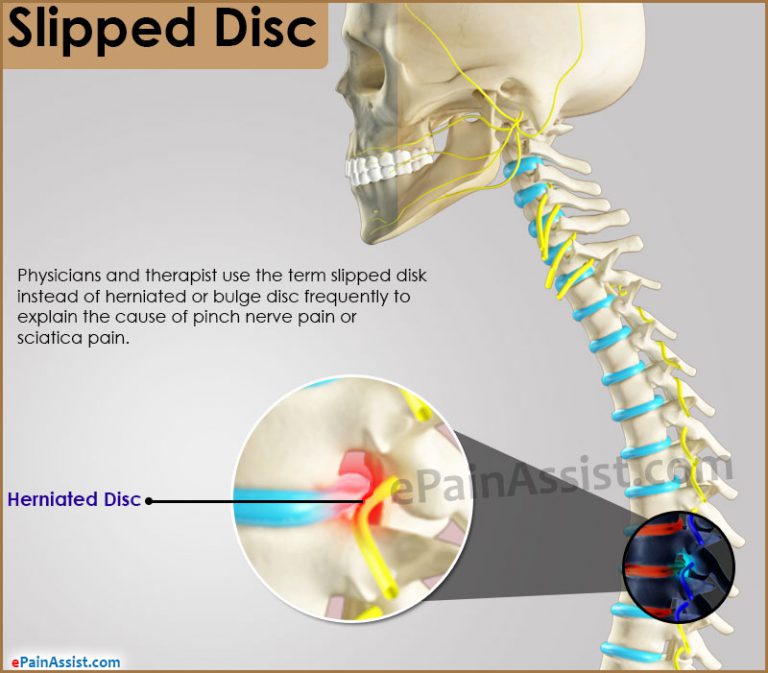 Slipped Disc: Disc Anatomy, Symptoms, Signs, Investigations, Treatment, Medications, Biofeedback, Preventive Measures