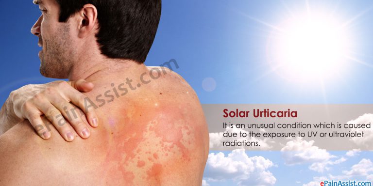 What Causes Solar Urticaria And How Can It Be Treated?