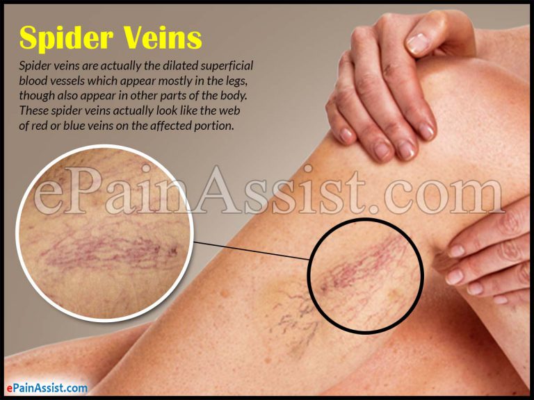 What Causes Spider Veins and Treatments to Get Rid of it