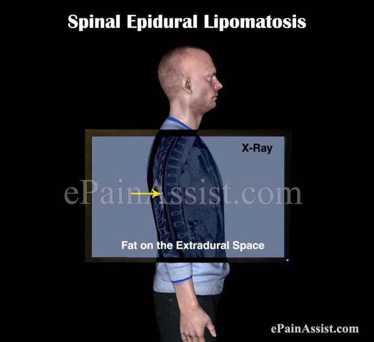 Spinal Epidural Lipomatosis: Causes, Symptoms, Treatment