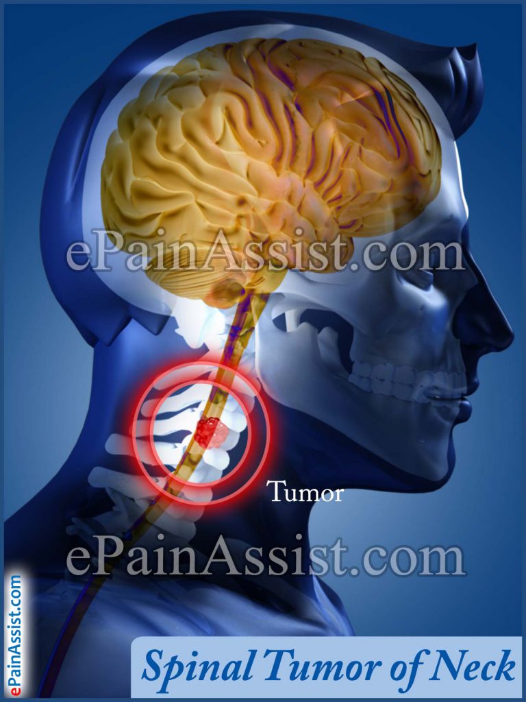 Spinal Cord Tumor in Neck