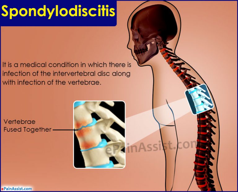 What Is Spondylodiscitis?