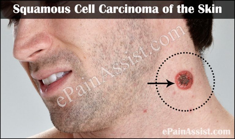 Squamous Cell Carcinoma of the Skin: Causes, Symptoms, Treatment, Prevention