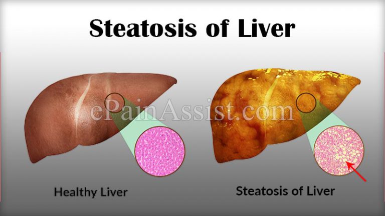 Steatosis of Liver: Causes, Symptoms, Treatment, Diet, Pathophysiology, Epidemiology, Prevention