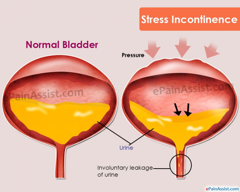 Stress Incontinence: Causes, Symptoms, Treatment, Lifestyle Modifications