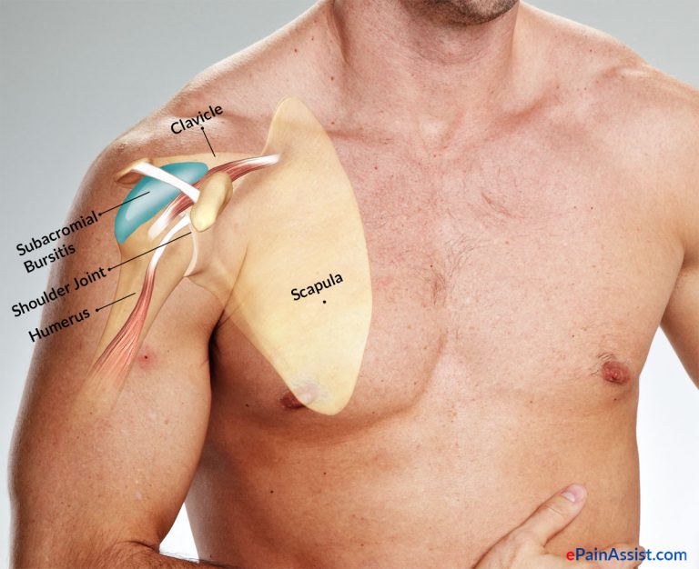 Subacromial Bursitis: Causes, Risk Factors, Symptoms, Diagnosis, Treatment, Exercise