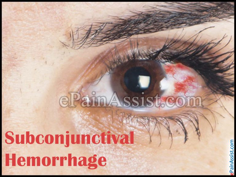 Subconjunctival Hemorrhage : Causes, Symptoms, Treatment, Diagnosis