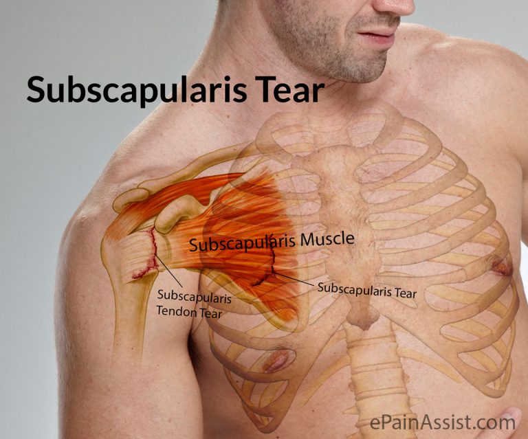 Subscapularis Tear: Causes, Symptoms, Signs, Treatment, Diagnosis, Investigations