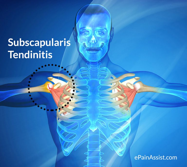 Subscapularis Tendinitis: Causes, Symptoms, Treatment, Recovery, FAQ on Subscapularis Tendon Repair Surgery