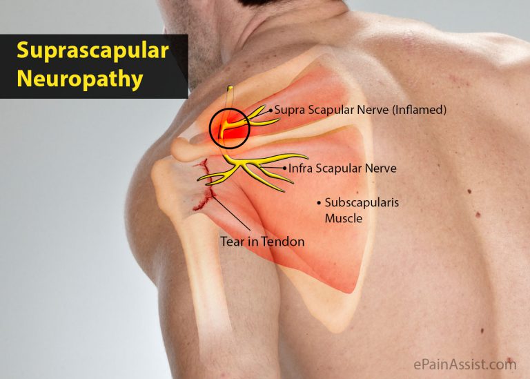 Suprascapular Neuropathy: Definition, Causes, Symptoms, Diagnosis, Treatment