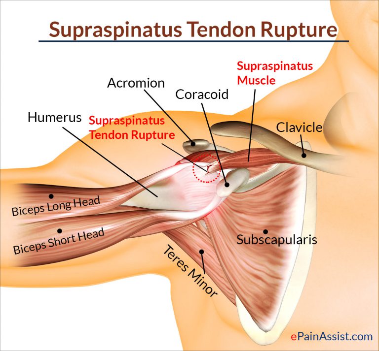 Supraspinatus Rupture: Causes, Symptoms, Diagnosis, Treatment