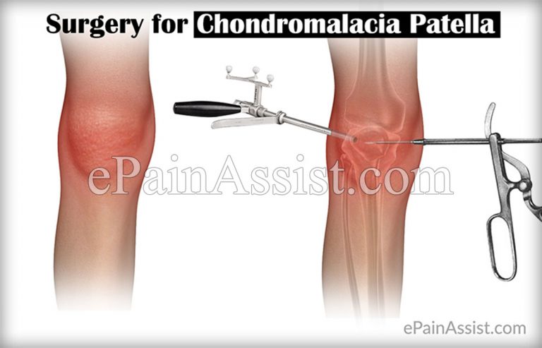 Treatment, Surgery, Recovery of Chondromalacia Patella