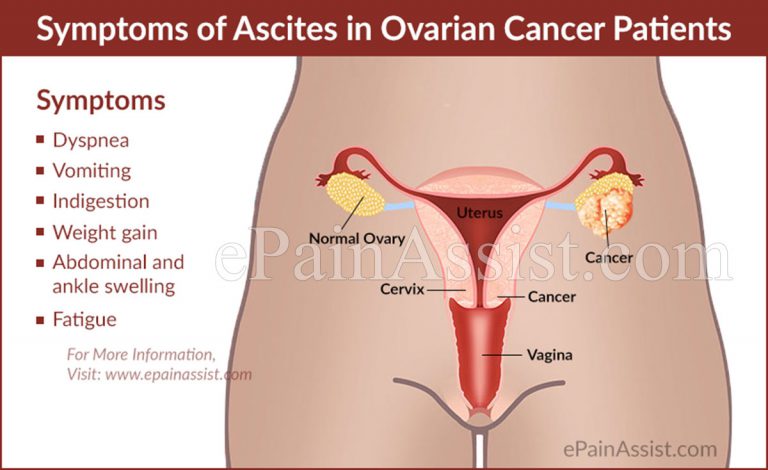 Ascites in Ovarian Cancer Patients