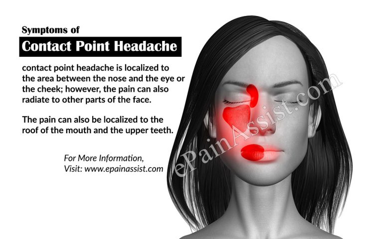 Contact Point Headache: Causes, Symptoms, Signs, Treatment, Diagnosis