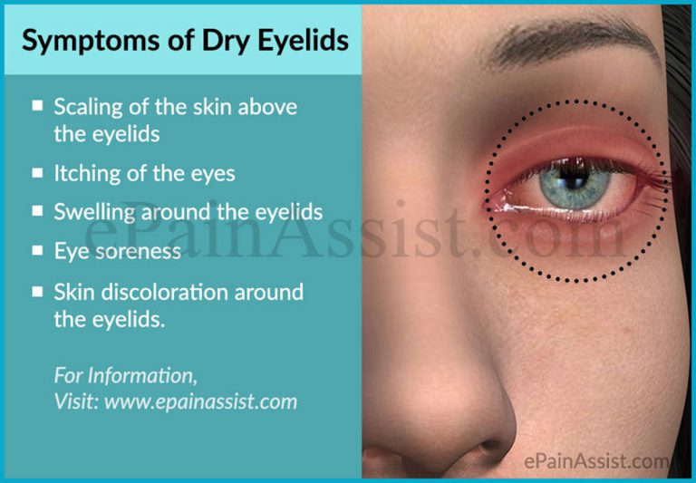 Dry Eyelids : Causes, Symptoms, Treatment