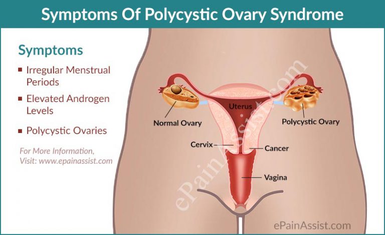 Polycystic Ovary Syndrome (PCOS) : Causes, Symptoms, Diagnosis, Treatment, Home Remedies