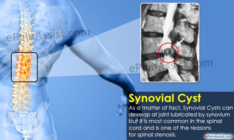 What Is Synovial Cyst And How Is It Treated?