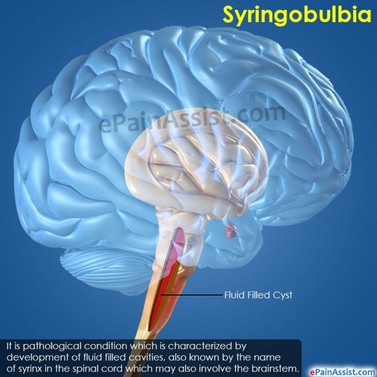 Syringobulbia: Causes, Symptoms, Treatment