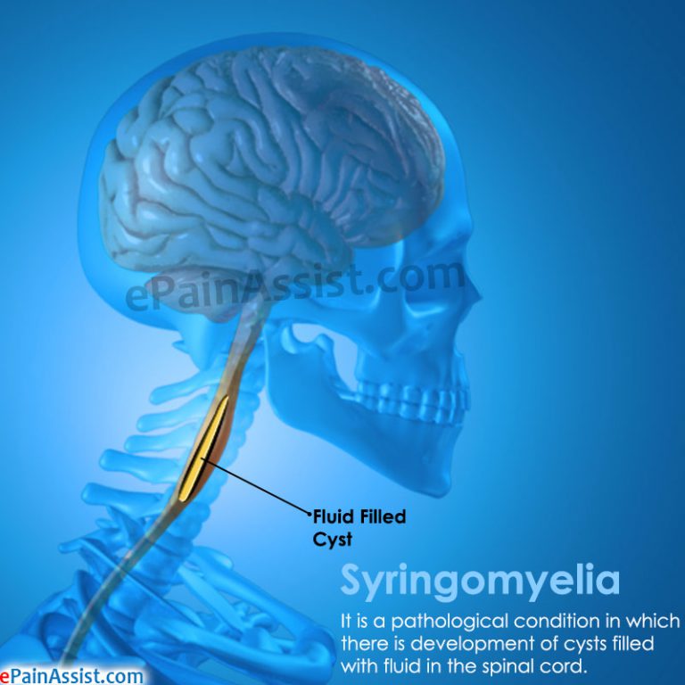 Syringomyelia: Causes, Symptoms, Treatment, Diagnosis
