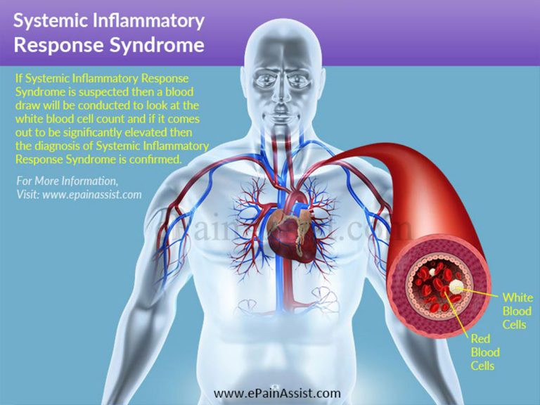Systemic Inflammatory Response Syndrome – Causes, Symptoms, Diagnosis, Treatment