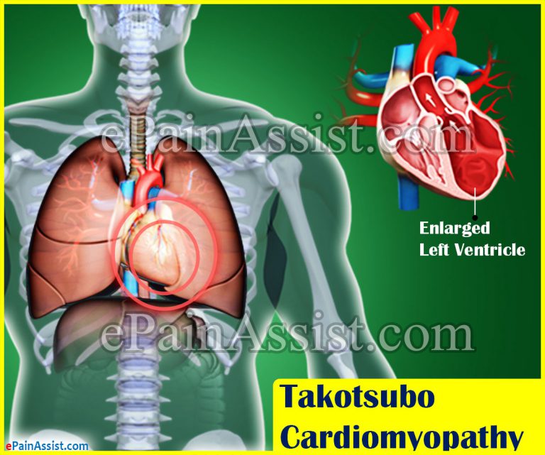 Takotsubo Cardiomyopathy or Broken Heart Syndrome: Causes, Symptoms, Treatment