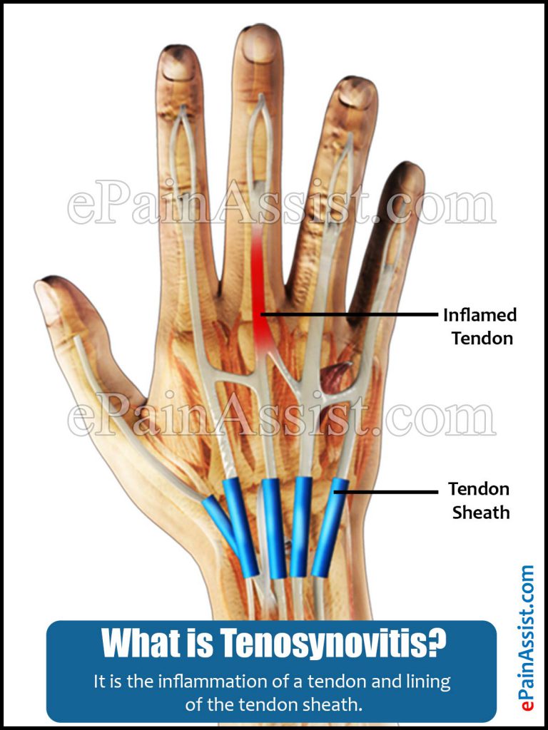 Synovitis and Tenosynovitis