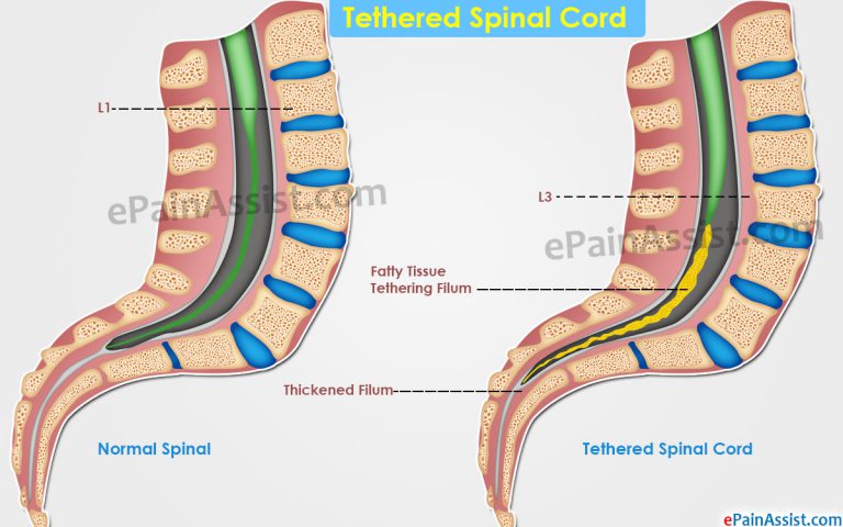 Tethered Spinal Cord: Causes, Symptoms, Treatment, Diagnosis