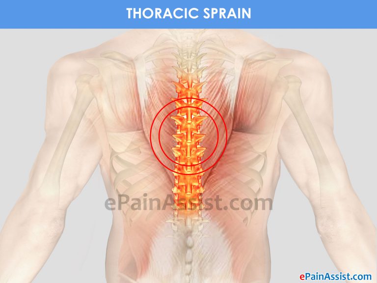 Thoracic Sprain:  Causes, Symptoms, Treatment, Prevention, Exercises