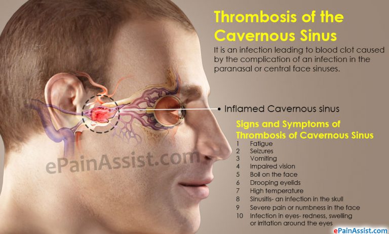 Thrombosis of the Cavernous Sinus: Symptoms, Causes, Treatment, Complications