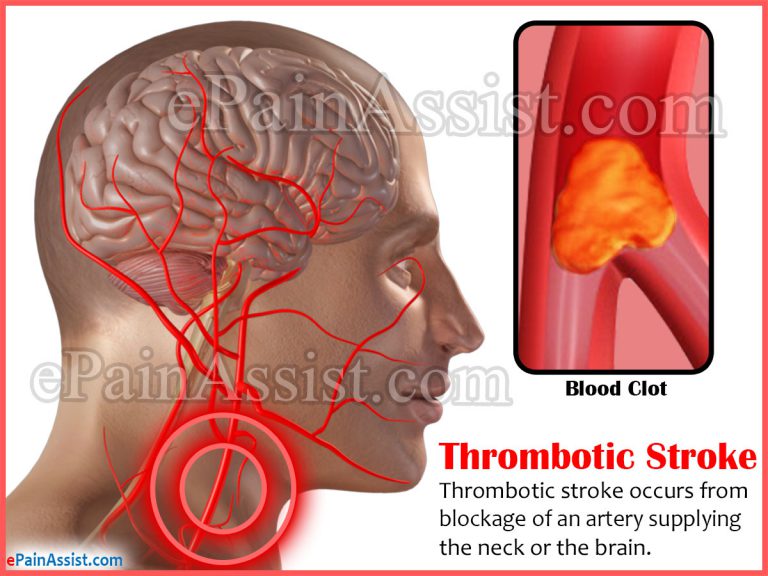 Thrombotic Stroke: Types, Causes, Symptoms, Treatment, Recovery Period