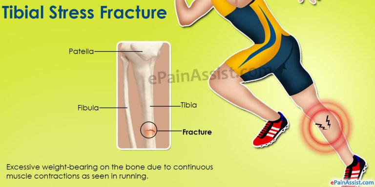 Tibial Stress Fracture: Symptoms, Causes, Diagnosis, Treatment