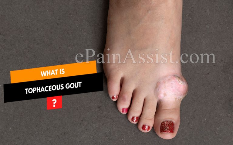 Tophaceous Gout : Causes, Symptoms, Treatment