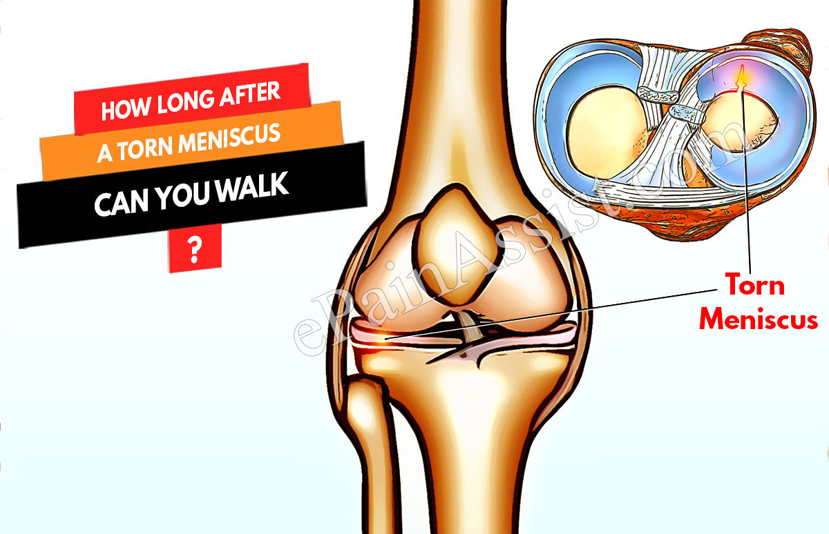 Torn Meniscus : How Long After A Torn Meniscus Can You Walk?