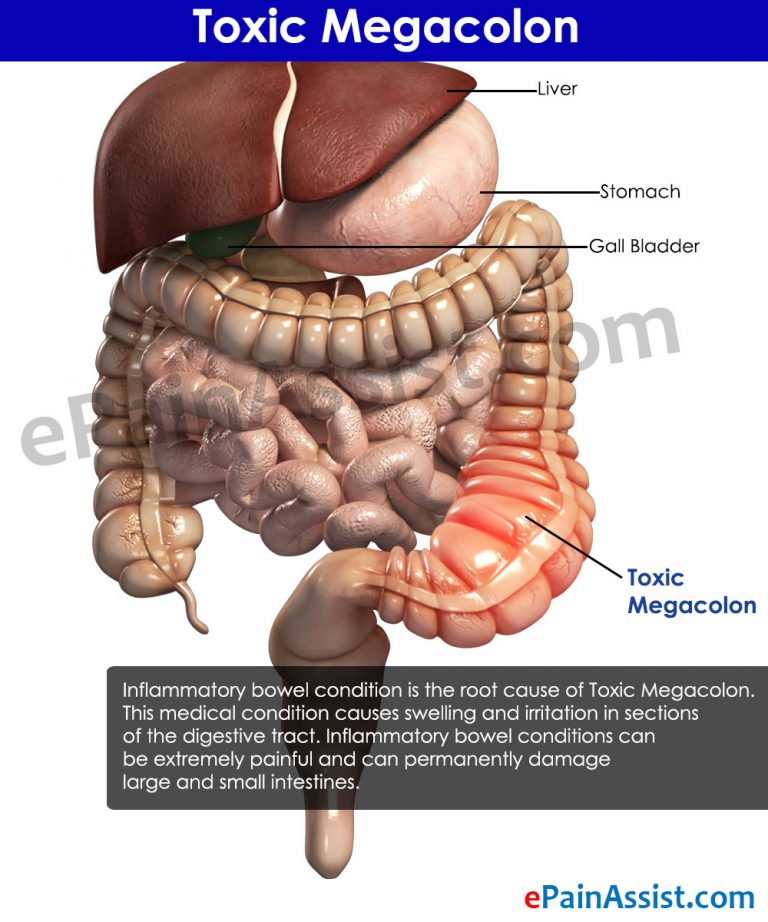 Toxic Megacolon: Causes, Symptoms, Diagnosis, Treatment, Prognosis