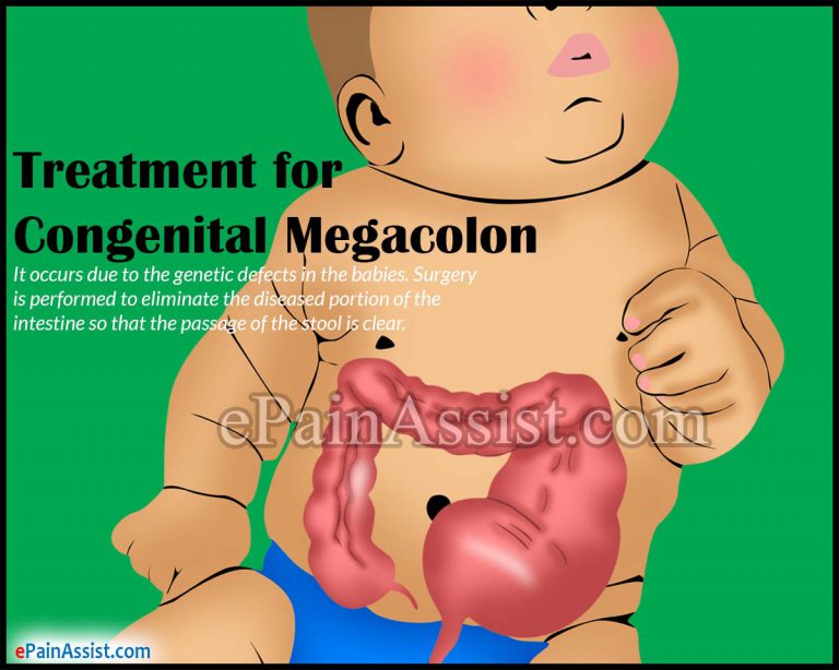 Treatment for Congenital Megacolon or Congenital Aganglionic Megacolon