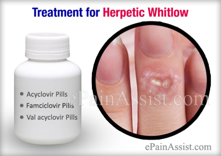 Herpetic Whitlow or Whitlow Finger: Treatment, Risk Factors, Complications