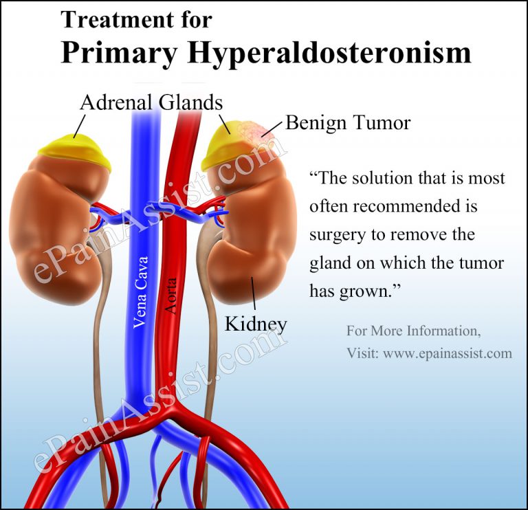 Primary Hyperaldosteronism or Primary Aldosteronism : Treatment, Complications, Risk Factors