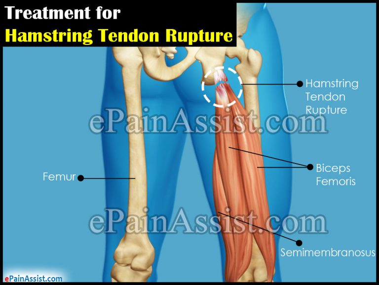 Treatment for Hamstring Tendon Rupture|Surgical|Non Surgical