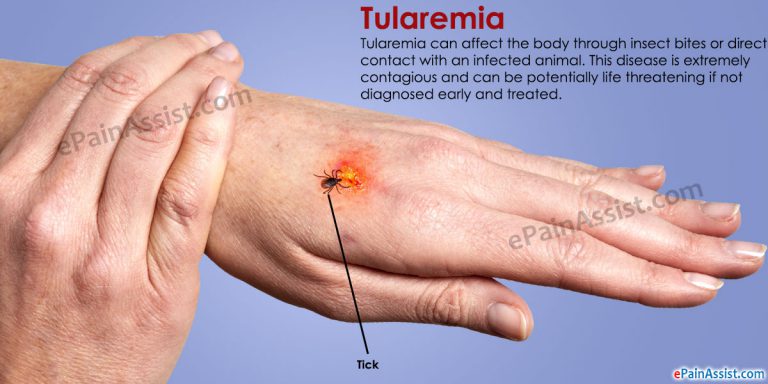 Tularemia: Causes, Symptoms, Treatment