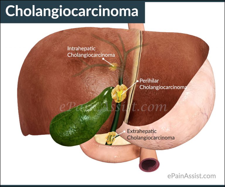 Cholangiocarcinoma: Types, Staging, Diagnosis