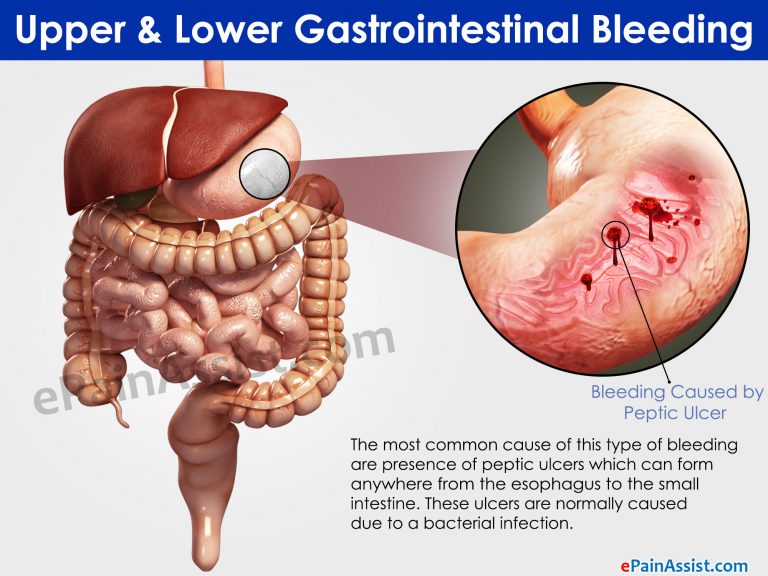 Upper & Lower Gastrointestinal Bleeding: Causes, Risk Factors, Symptoms, Treatment, Home Remedies